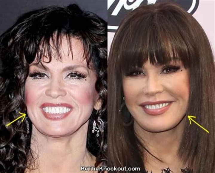 Has Marie Osmond Had Plastic Surgery?